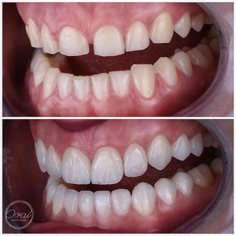 Natural Laminate Veneers Case 2 | Oval Dental Clinic