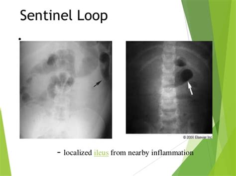 Sentinel Loop