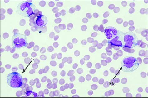 Peripheral Blood Fi Lm Of Patient Showing Immature Granulocytes G | My XXX Hot Girl