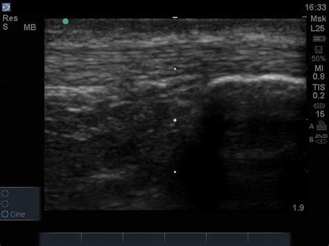 Ultrasound Evaluation: Achilles Tendon EMRA