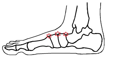 Dorsal Midfoot Compression - Ankle, Foot and Orthotic Centre