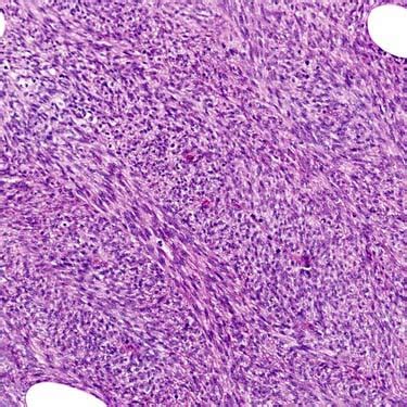 Fibrosarcoma Histology