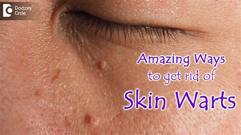 AMAZING WAYS TO GET RID OF SKIN WARTS | Skin Wart Removal Tips - Dr ...