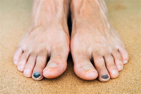 How to Heal a Bruised Toenail? Try These Hacks | ND Nails Supply