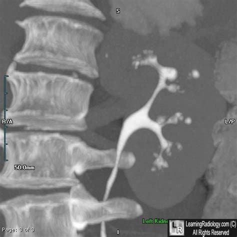 LearningRadiology - Renal papillary necrosis