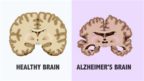 What are the 4 stages of Alzheimer and their effects? | CircleCare