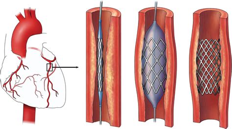 Over 2 Million Stents Implanted per Year in the U.S. - iData Research