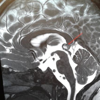 Pineal Cyst | MRI Imaging of Pineal Cyst - ABRAM MAYHEM