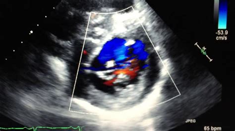 Cleft Mitral Valve Anterior Leaflet