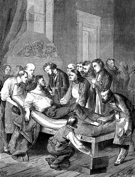 William Morton using ether anaesthesia, 19th C illustration - Stock Image - C037/9418 - Science ...