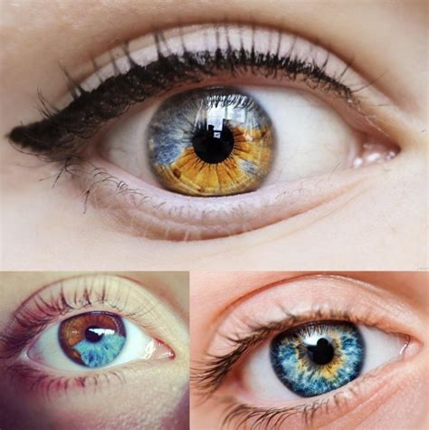 Laser Treatment for Heterochromia-Causes of Heterochromia