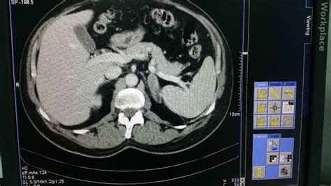 Minimally invasive surgery: laparoscopic adrenalectomy