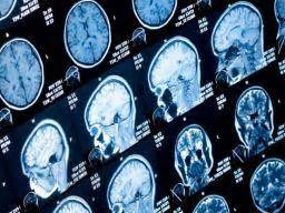 ADHD: Large imaging study confirms differences in several brain regions