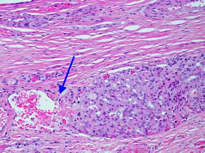 Types Of Thyroid Cancer Hurthle Cell - CancerWalls