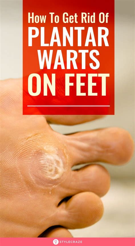 How To Get Rid Of Plantar Warts On Feet Naturally | Warts remedy ...