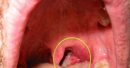 Northland Ear Nose and Throat: A new epidemic- Oral cancer due to HPV