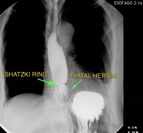 Schatzki ring causes, symptoms, diagnosis, treatment & prognosis