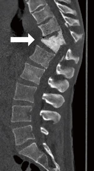 Gibbus deformity after non-tuberculosis osteomyelitis - Seksenyan ...