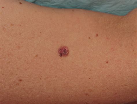 Melanoma Image 1B - Large