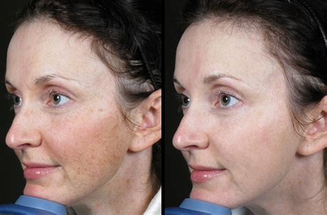 Laser Brown Spots 5 - MD ESTHETICS