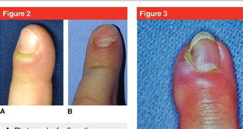 Acute Paronychia Treatment