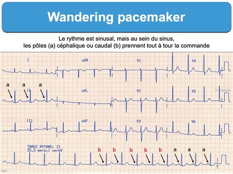 Wandering pacemaker (WPM) : e-cardiogram