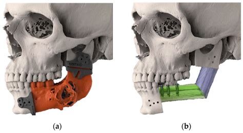 JCM | Free Full-Text | Accuracy Evaluation of an Alternative Approach for a CAD-AM Mandibular ...