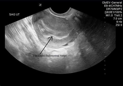 Early Pregnancy | Sonoguide