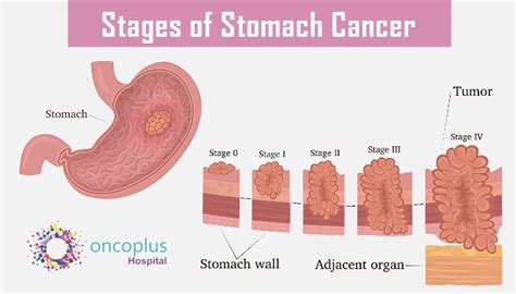 Stomach Cancer Stages Chart