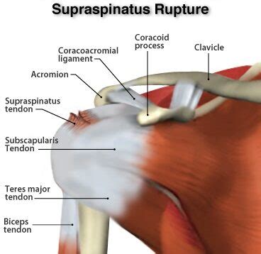 Supraspinatus Tear - Xcell Medical Group - Elyria, Ohio