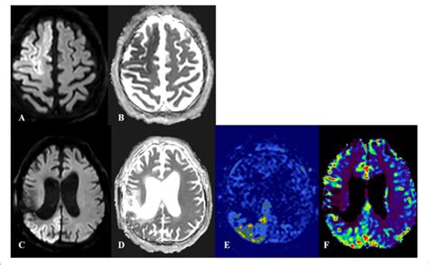 | Cortical laminar necrosis in acute ischemic stroke (AIS) and status... | Download Scientific ...