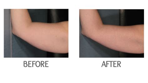 Upper Arm Tightening In Los Angeles - Skin Treatment in LA