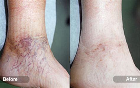 spider veins | Laser Hair Removal Center, Style MedSpa | Get Hair Less