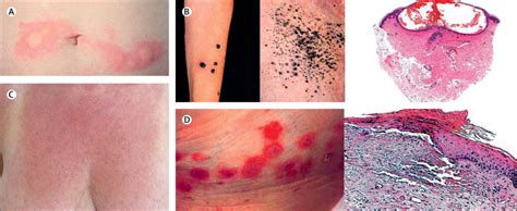 Heparin-induced skin lesions - The Lancet