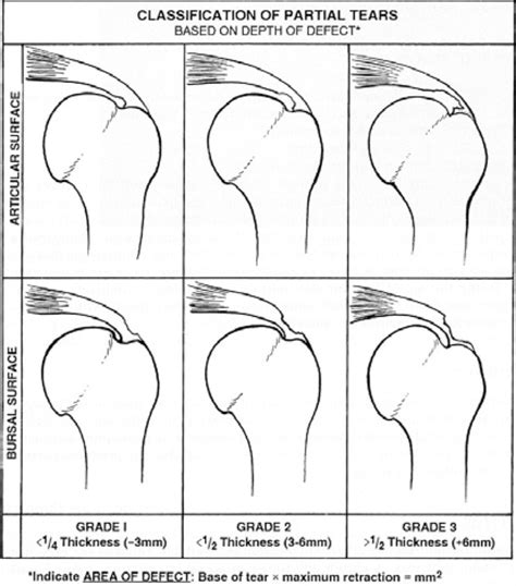 Surgical Treatment Options for Partial Rotator Cuff Tears: A Review of the Literature | Borbas ...