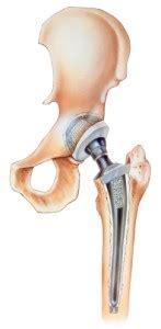 Anterior Hip Replacement - Orthopedic Specialists of Seattle