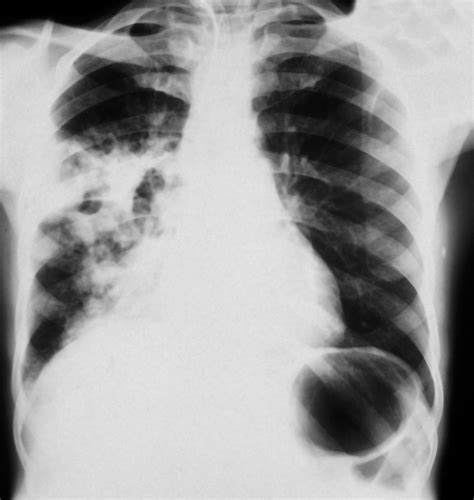 Pulmonary TB: plain chest x-ray | Wellcome Collection