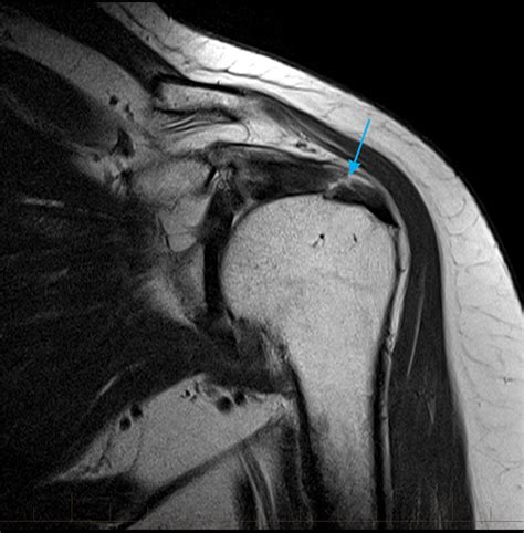 MRI Shoulder - Musculoskeletal Imaging