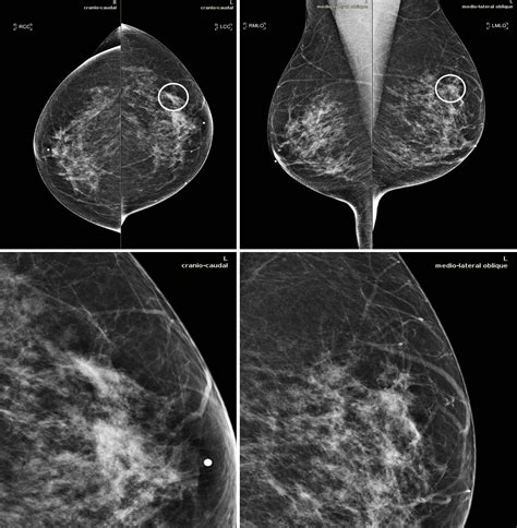 New Artificial Intelligence Tool Improves Breast Cancer Detection on Mammography