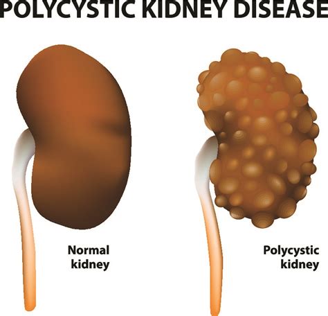 Polycystic Kidney Disease- Symptoms, Treatment & Causes - SKI