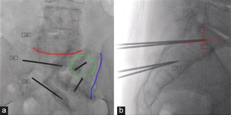 Percutaneous Sacroplasty for Sacral Insufficiency Fractures: Case Series and Review of ...