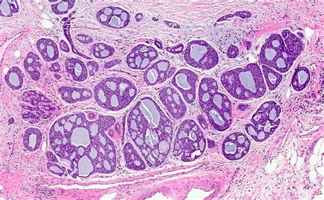 Adenoid Histology