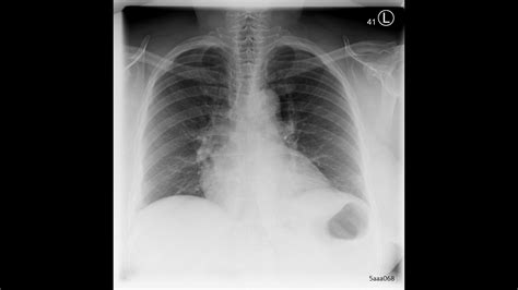 X-ray imaging for COVID-19 patients