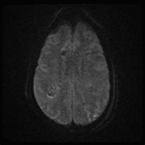 Diffuse axonal injury - wikidoc