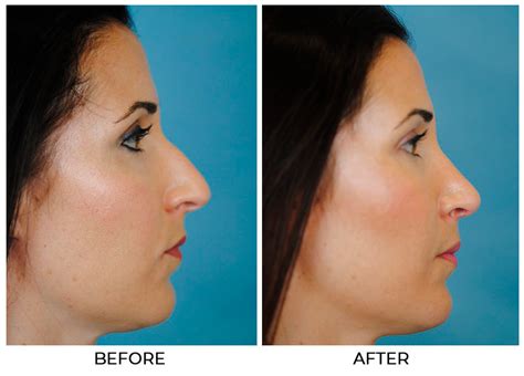 Cosmetic Rhinoplasty with Functional Septoplasty and Turbinate Reduction - Thomas Funcik MD | Blog