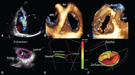 Rheumatic Tricuspid Valve Disease - Quotes Trending