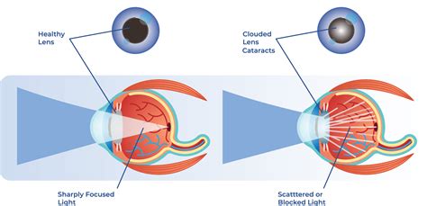 6 Things You Need To Know About Cataracts | EyeCarePro | Marketing