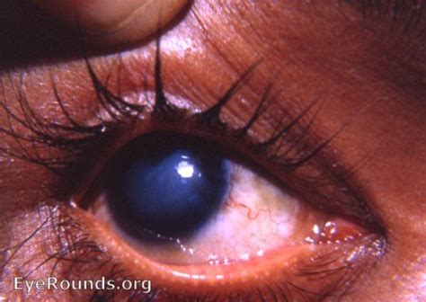 Syphilis: congenital interstitial keratitis. EyeRounds.org: Online ...