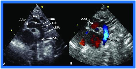 (A) Suprasternal notch view of a normal aortic arch (Arch)... | Download Scientific Diagram