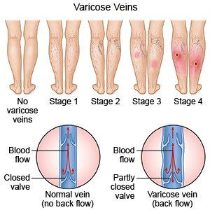 Varicose Veins - What You Need to Know